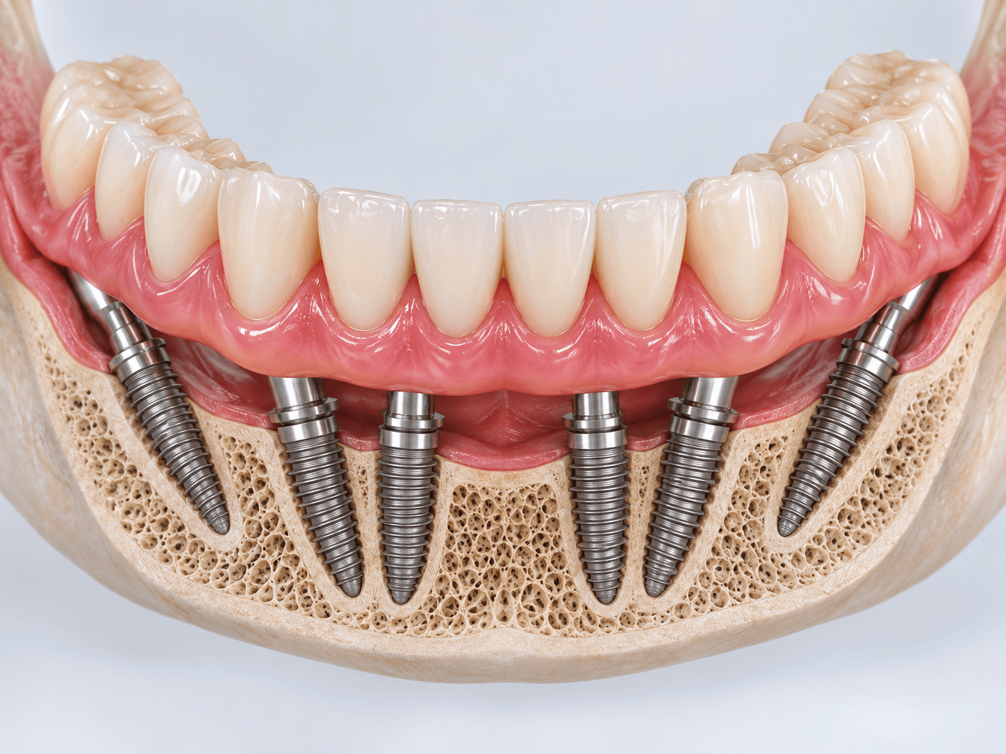 Basal & Immediate-Loading Implants aftercare